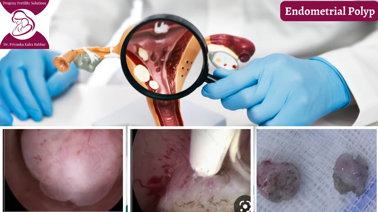 Case Study of Dr. Priyanka Kalra Babbar-Irregular Bleeding